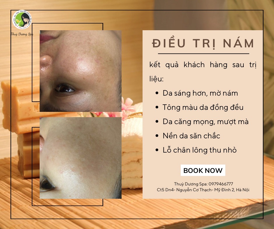 TRỊ NÁM HIỆU QUẢ